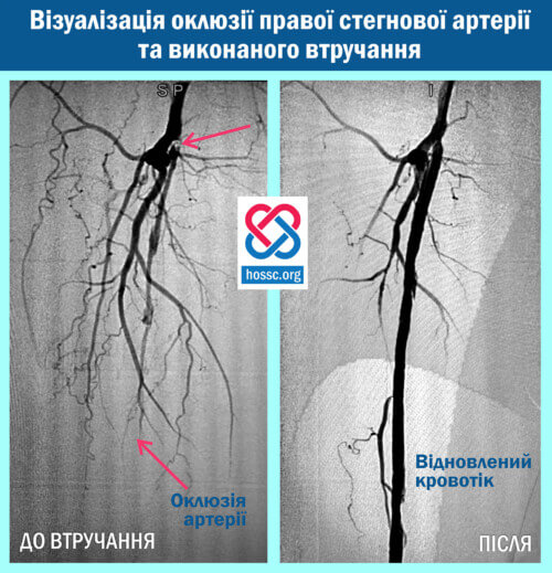 У Хмельницькому обласному серцево-судинному центрі дали військовому шанс на повноцінне життя